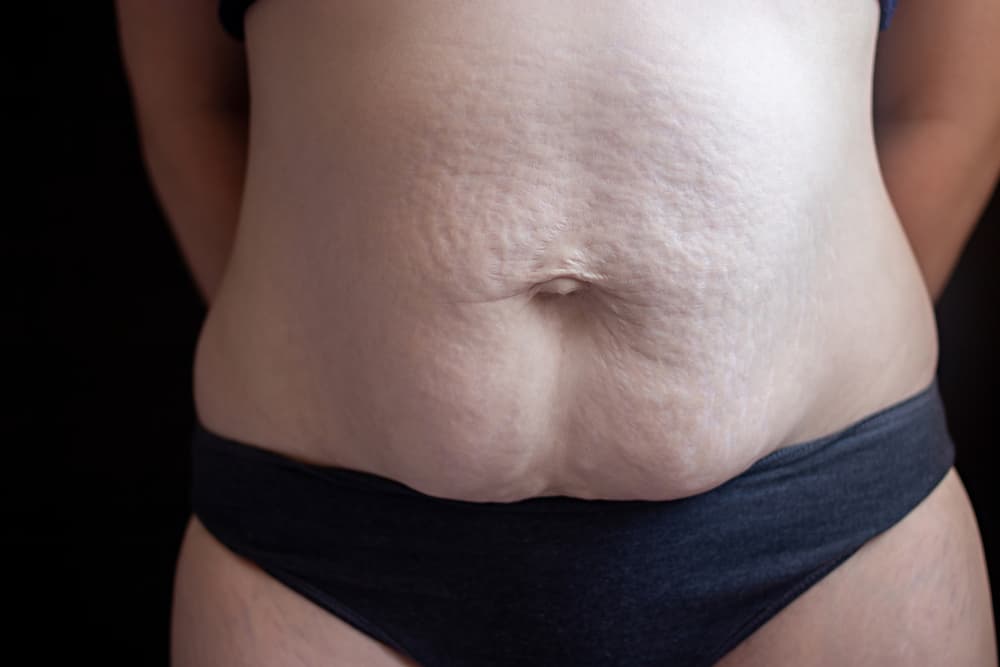 Can Stretch Marks Go Away?