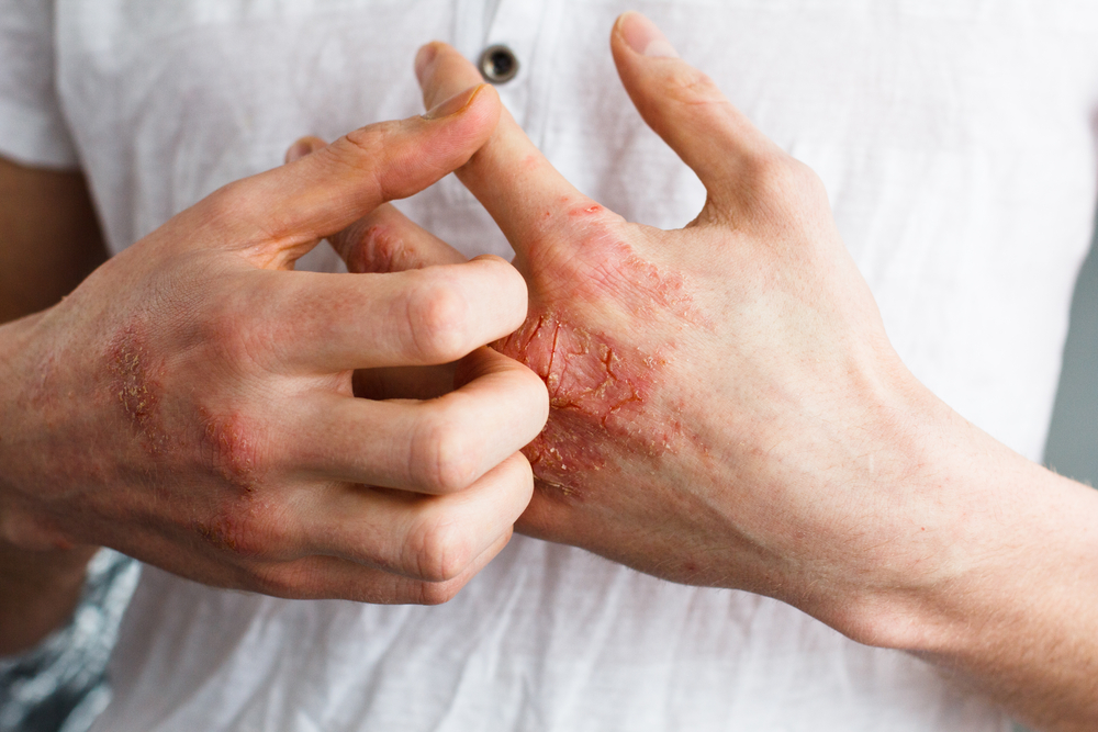 Psoriasis and Eczema Difference: How to Tell The Difference