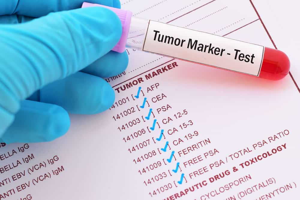 CA 15-3 Tumor Marker Test for Women: Why and How is it Done?