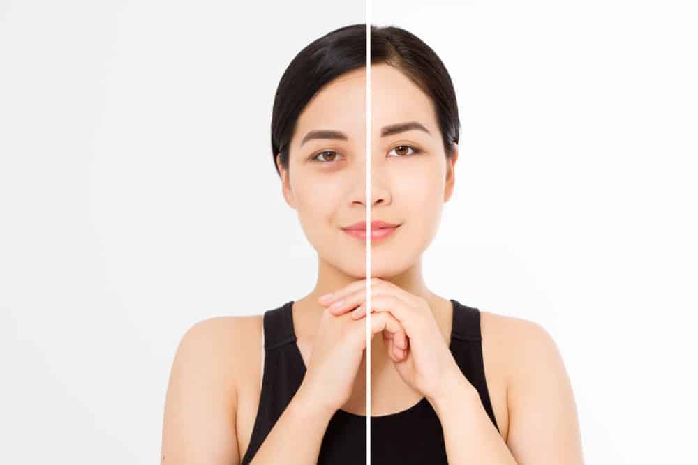 Eye Bag Removal: Home Remedies, Plus Medical, and Surgical Options