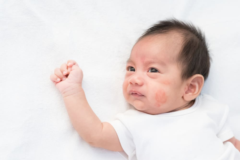 Help! What Is This Newborn Skin Rash? Should I Go to a Doctor?