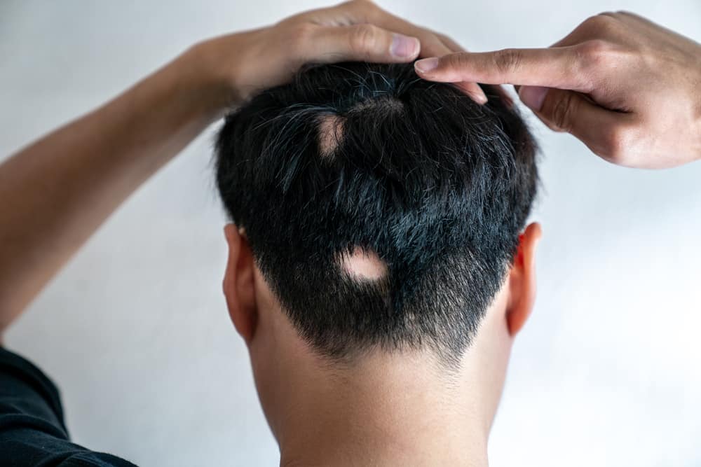 Signs of Alopecia: Should You Be Concerned About Hair Loss?