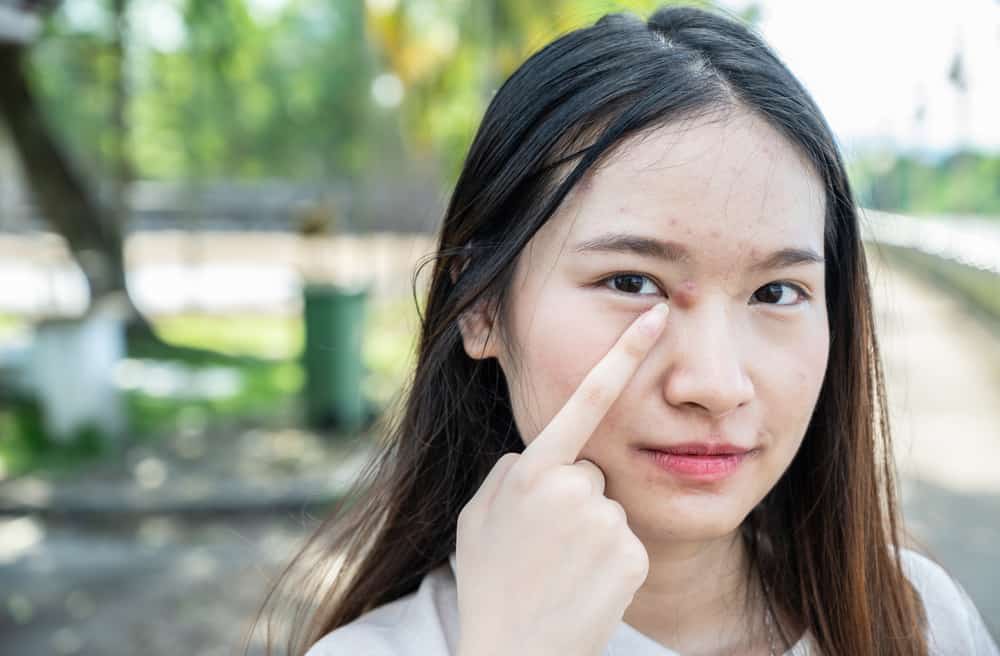Pimple with Pus: When Should You See a Derma?
