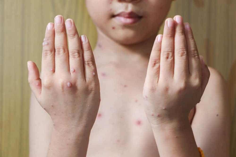 My Child Has Chickenpox — What To Do and How To Treat It