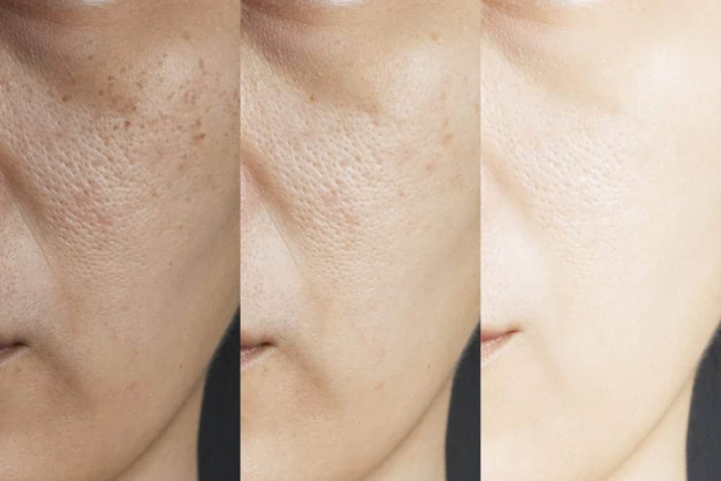 How To Minimize Pores Naturally