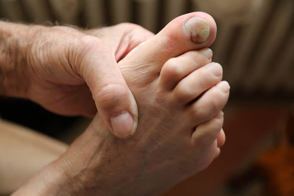 Diabetic Toenails: Changes To Watch Out For