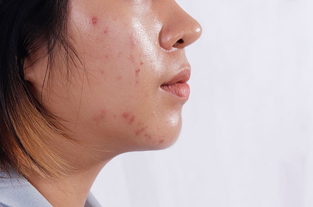 Oily Skin Care: 5 Things You Need To Avoid To Keep Your Skin Healthy