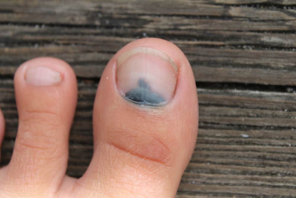 Black Toenail: 5 Possible Causes and Preventive Measures