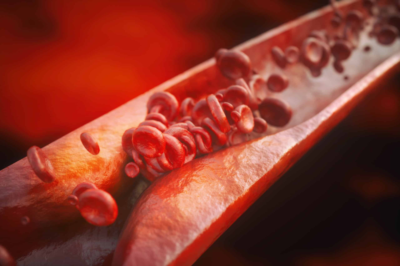 Atherosclerosis Diagnosis: What Tests Can Confirm Condition?