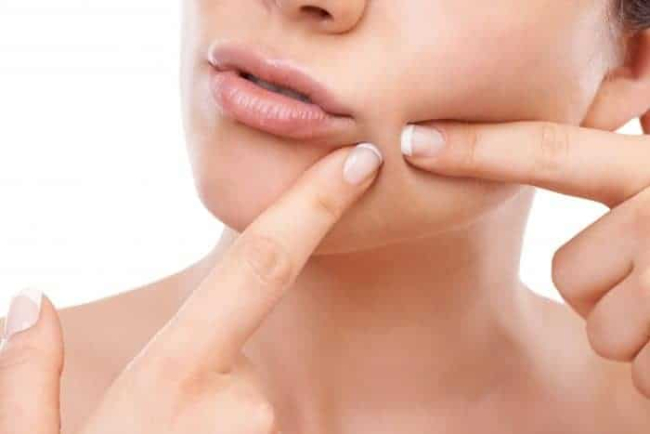 Popped A Pimple? Here's What To Do Next