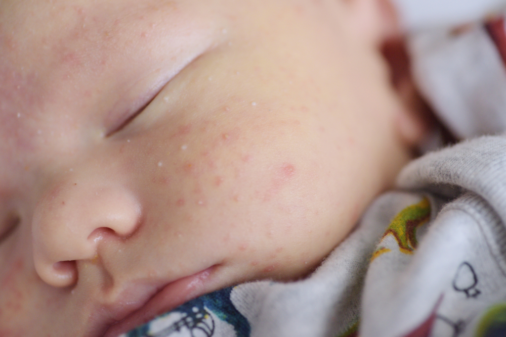 Neonatal Acne: Why Does My Newborn Have Pimples?