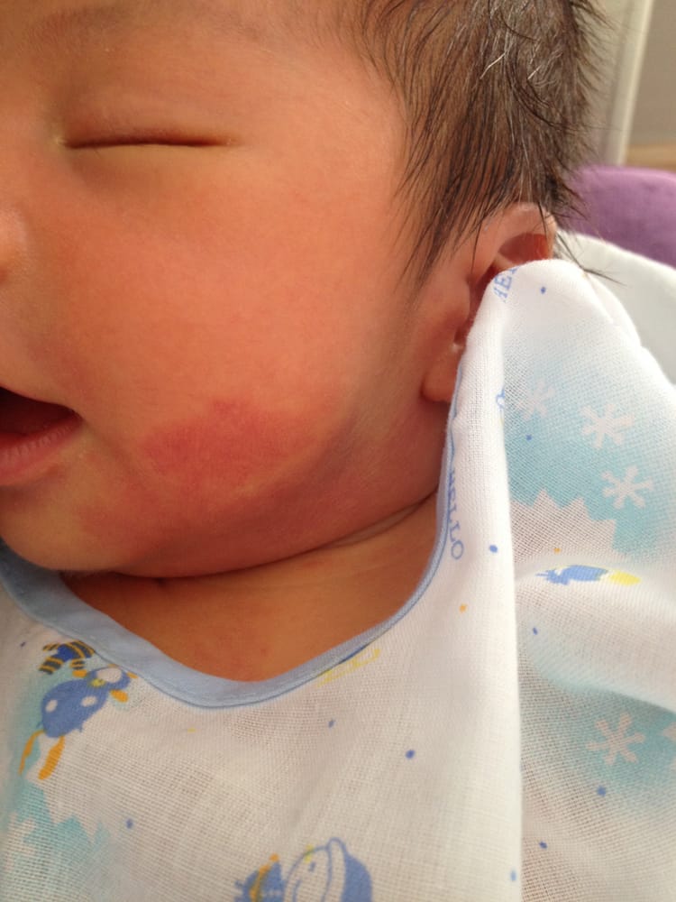 Port Wine Stain: Can This Birthmark Be Treated?