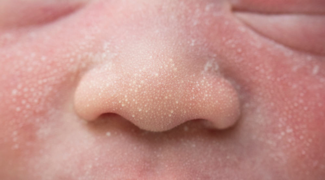 Milia in Newborn Babies: Should Parents Be Concerned?