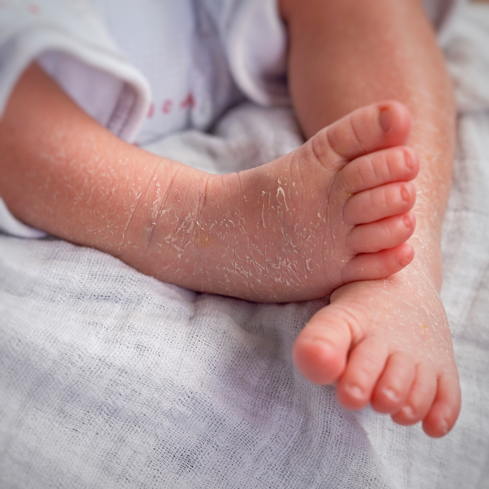 Newborn Skin Peeling: Is It Normal?