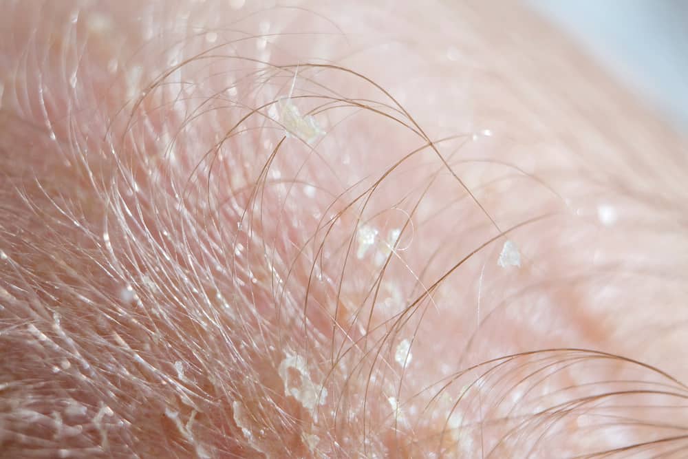 Cradle Cap Treatment: How To Get Rid of This Skin Condition in Infants