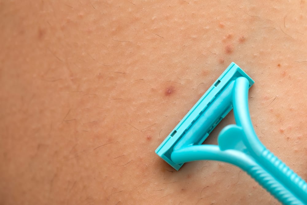 Get To Know More About Folliculitis Symptoms, Causes, and Treatment