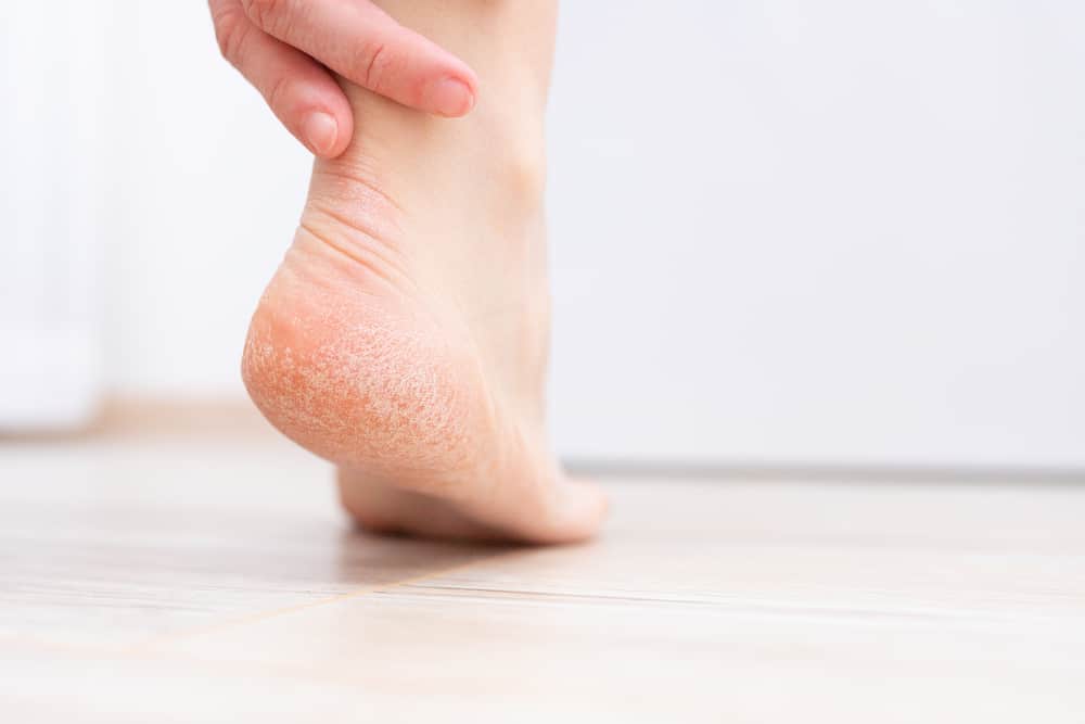 Bothered By Your Cracked Heels? Here’s How To Treat Them