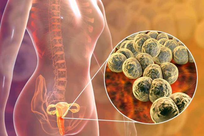Gamot Sa Gonorrhea: Heto Ang Tamang Gamot Sa Sakit Na Ito
