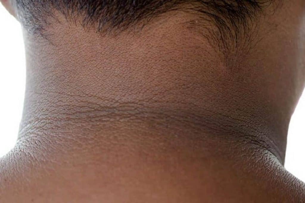 Maitim Na Batok: Ano Ang Sanhi Nito At Paano Maiiwasan?