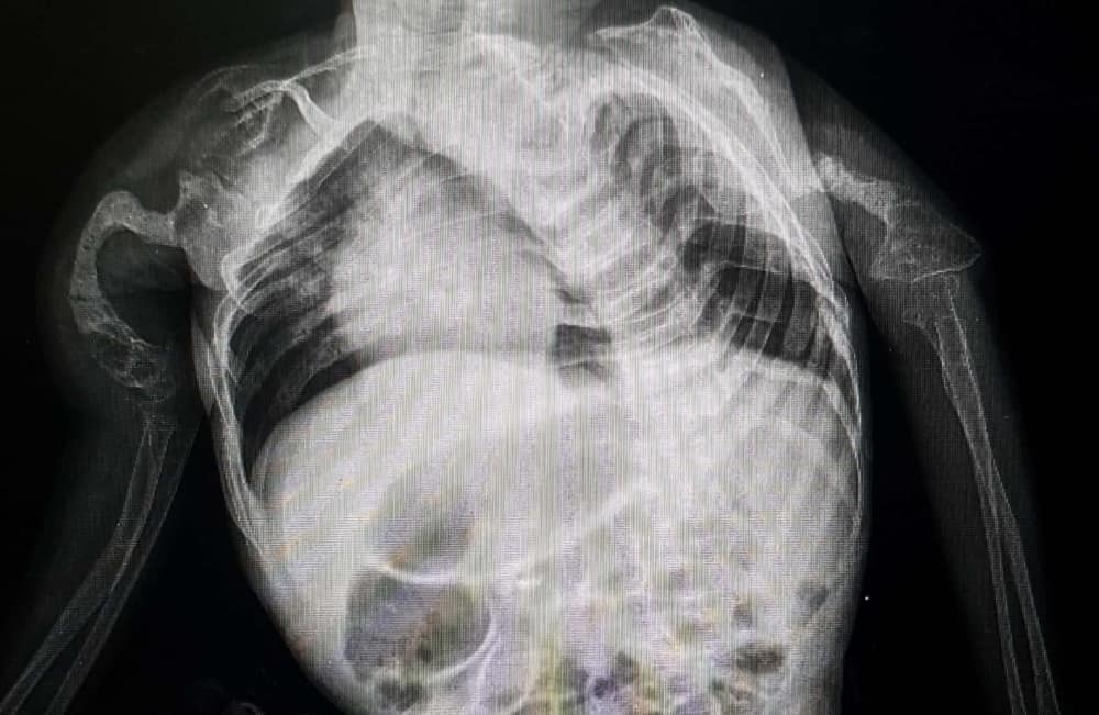 Osteogenesis Imperfecta: Why Do Bones Break Easily in Children?