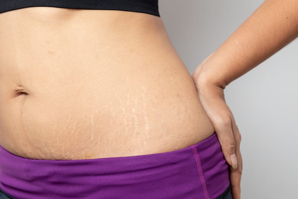How To Remove Stretch Marks According To Experts