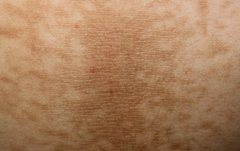 A Closer Look at Different Diabetic Rashes and Other Skin Conditions