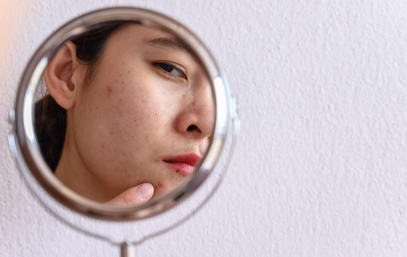 Acne Scarring: What You Need To Know