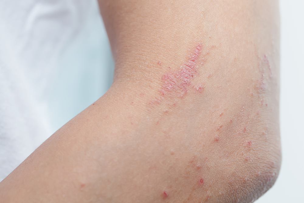 Keratosis Pilaris: Can You Smoothen Rough Skin?
