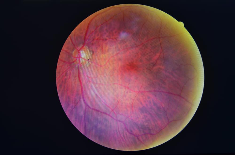 4 Complications of Diabetic Retinopathy
