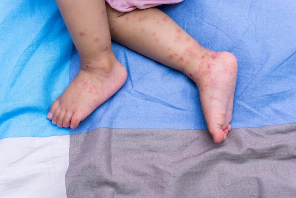 Sintomas Ng Hand, Foot, And Mouth Disease: Ito Ang Dapat Malaman Ng Mga Magulang