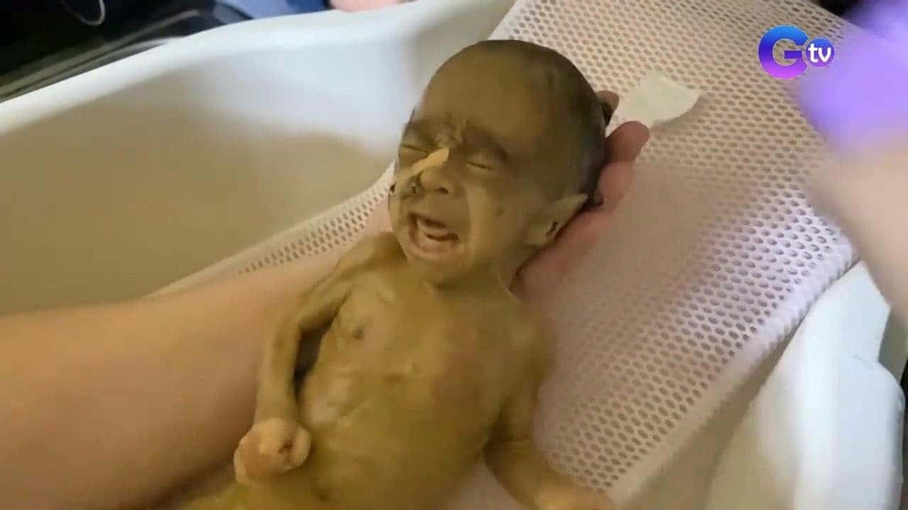 Ano Ang Edwards Syndrome, At Paano Ito Nakakaapekto Sa Kalusugan?