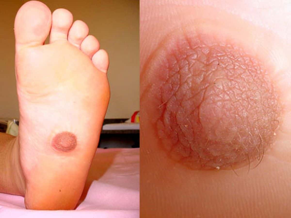 Ano ang Supernumerary Nipple sa katawan ng tao? Alamin dito!