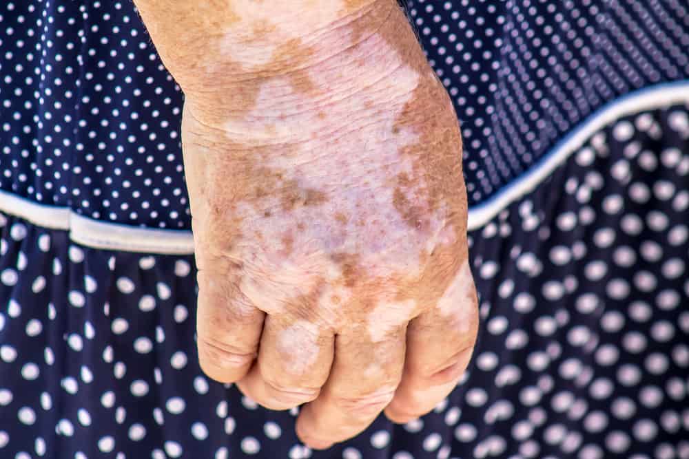 Gamot sa Vitiligo: Paano I-Manage ang Kondisyong ito sa Balat?