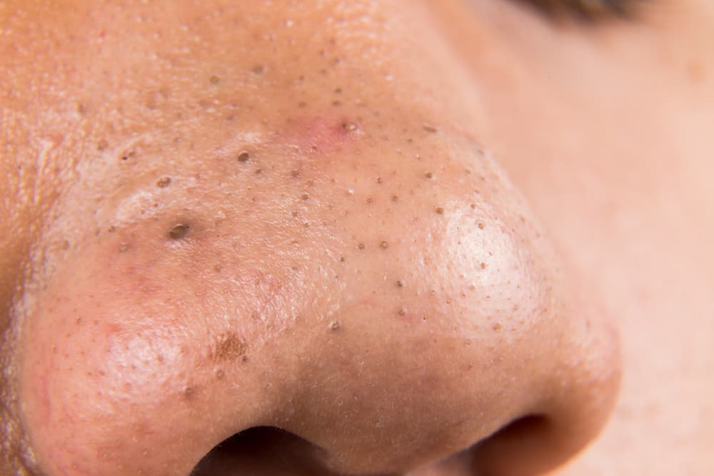 How To Remove Blackheads On Nose?