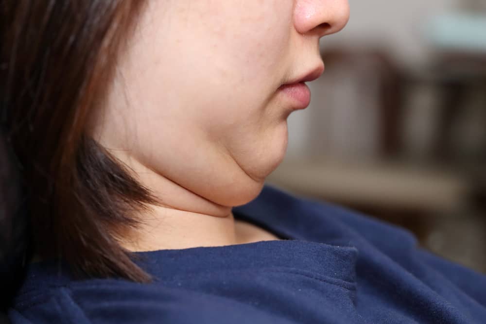 Kybella Injection: Getting Rid Of That Double Chin