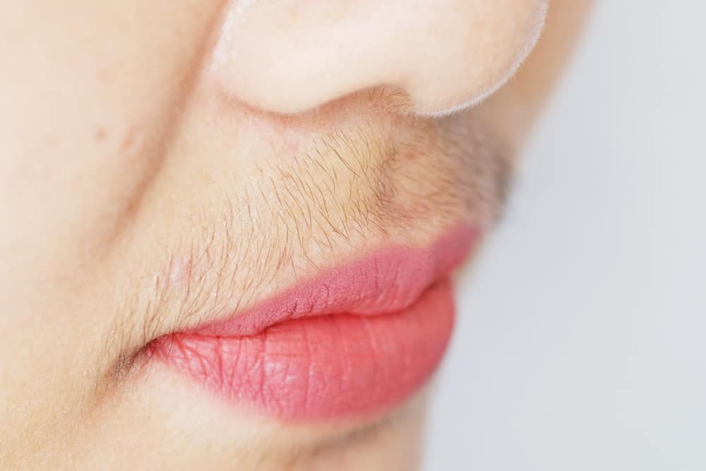 What Is Hirsutism? How Can You Address This Concern?