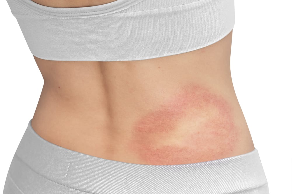 Fungal Infection sa Balat: Alamin Dito!