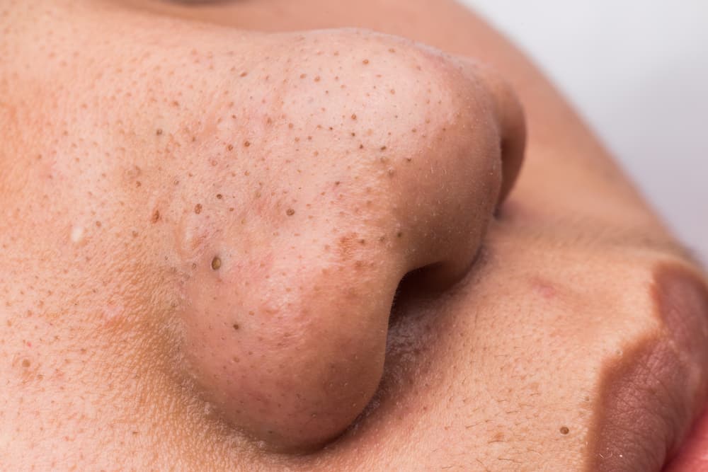 Looking For An Inexpensive Way To Treat Blackheads? Try Salicylic Acid!