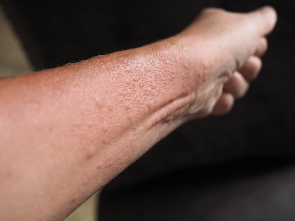 Uri Ng Dermatitis, Alamin Ang Mga Ito Dito