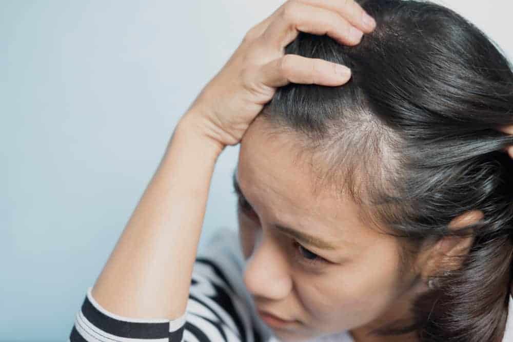 Ano Ang Sanhi ng Balakubak? Heto Ang mga Dapat Mong Malaman