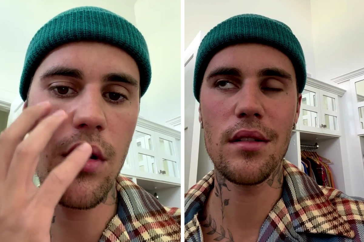 Ramsay Hunt Syndrome: Alamin ang sakit na kinakaharap ni Justin Bieber