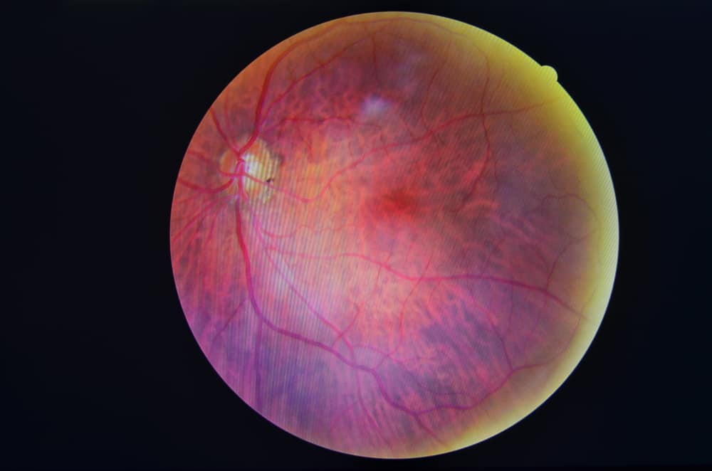 Komplikasyon Ng Diabetic Retinopathy, Anu-Ano Nga Ba?