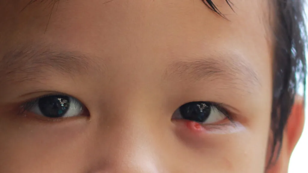 Kuliti sa Bata: Alamin ang Sanhi, Sintomas, at Gamot para Dito