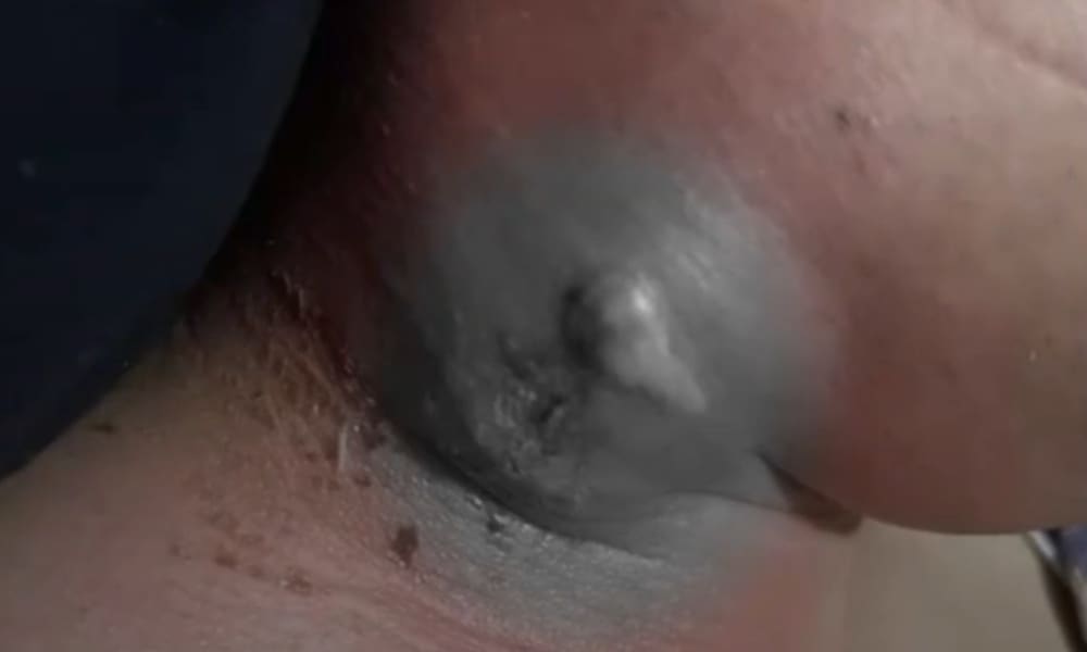 Ngipin Sa Leeg, Paano Ito Naging Posible? Alamin Dito!