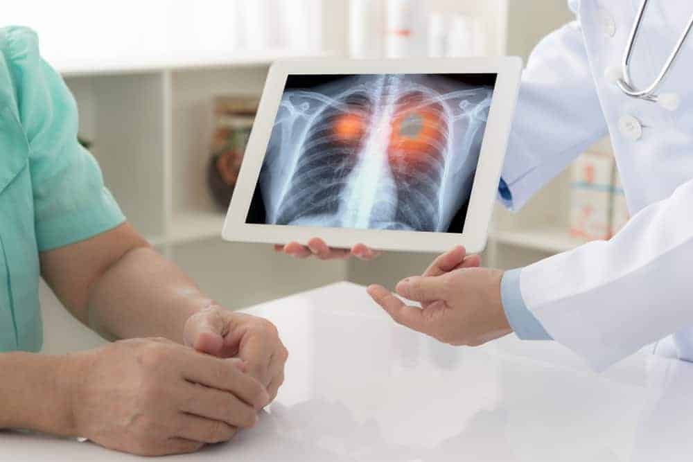 Dapat Malaman Tungkol Sa Lung Cancer: Facts Na Dapat Tandaan