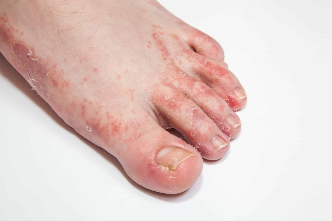 Fungal Infection Sa Balat: Maaari Ba Itong Maging Sanhi Ng Pangangati?