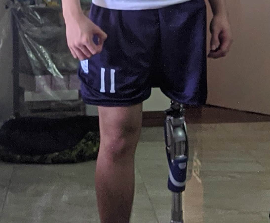 Epekto Ng Flesh-Eating Bacteria, Anu-Ano Ito? Alamin Dito!