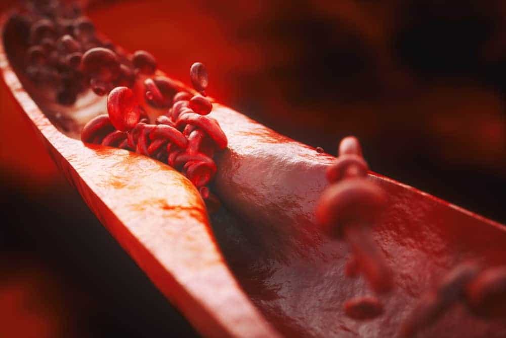 Ano Ang Atherosclerosis? Heto Ang Mga Dapat Mong Malaman