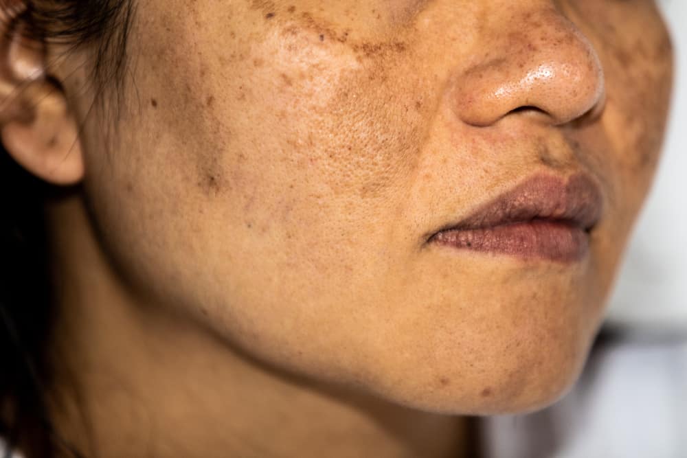 Ano Ang Hyperpigmentation At Paano Nangingitim Ang Balat?