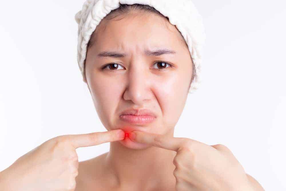 Sanhi ng Hormonal Acne, Anu-ano nga ba?